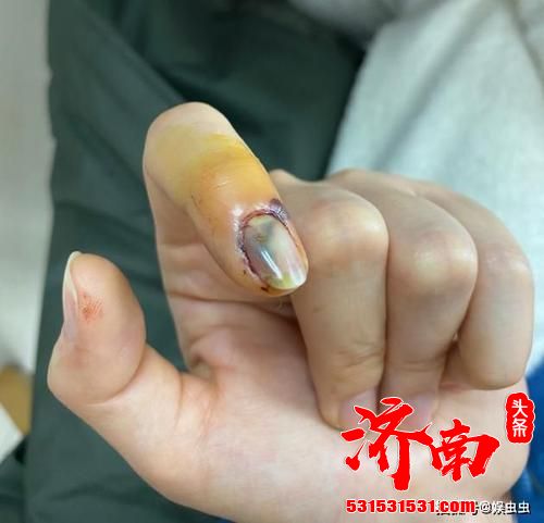 宋祖儿的手不小心被门夹到了,痛到无法拍戏 宋祖儿的手不小心被门夹到了,痛到无法拍戏